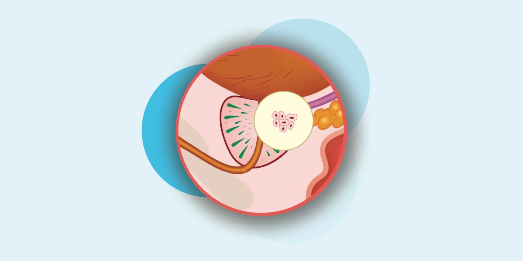 Fase 1 en tumor de próstata