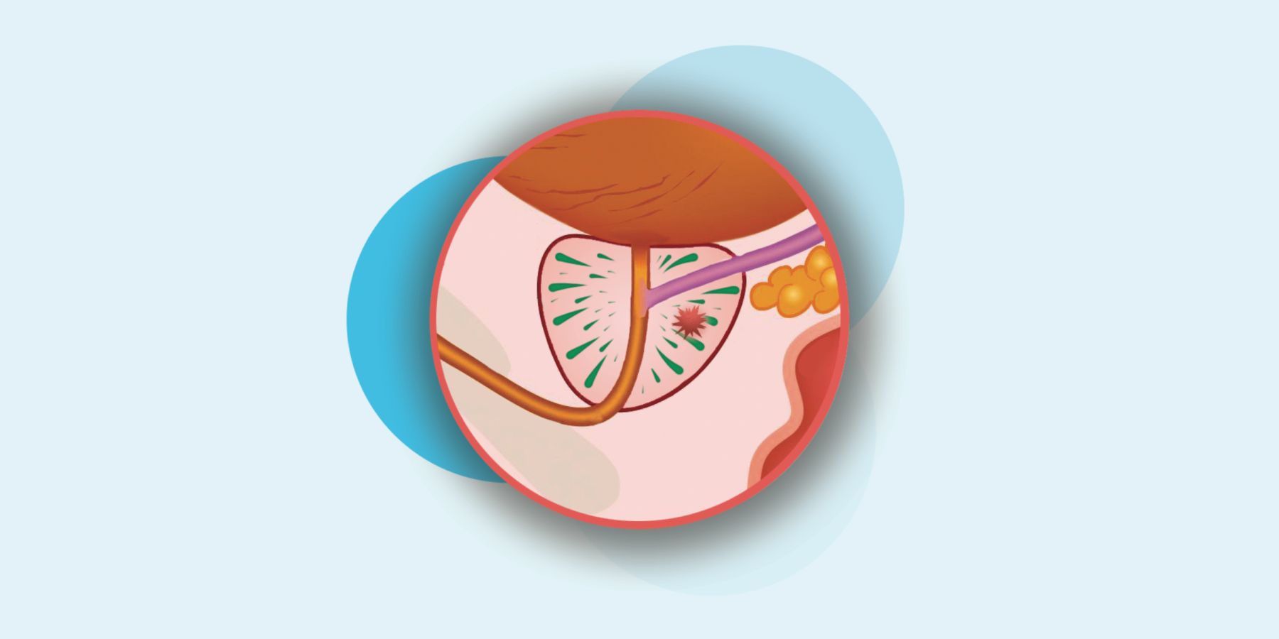 Fase 2 en tumor de próstata