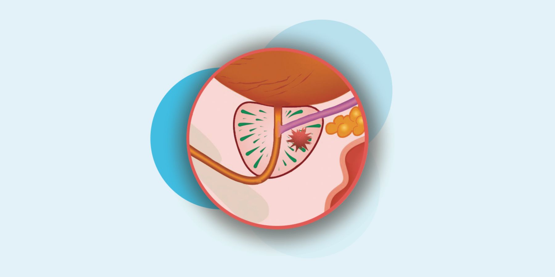 Fase 3 en tumor de próstata