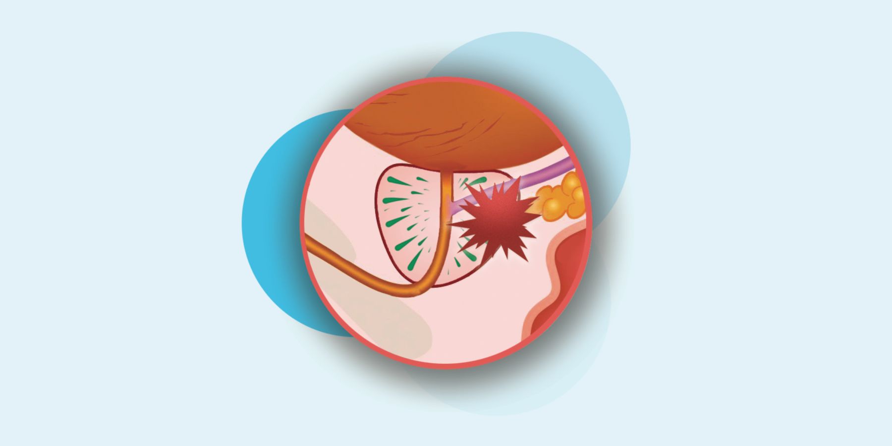 Fase 4 en tumor de próstata