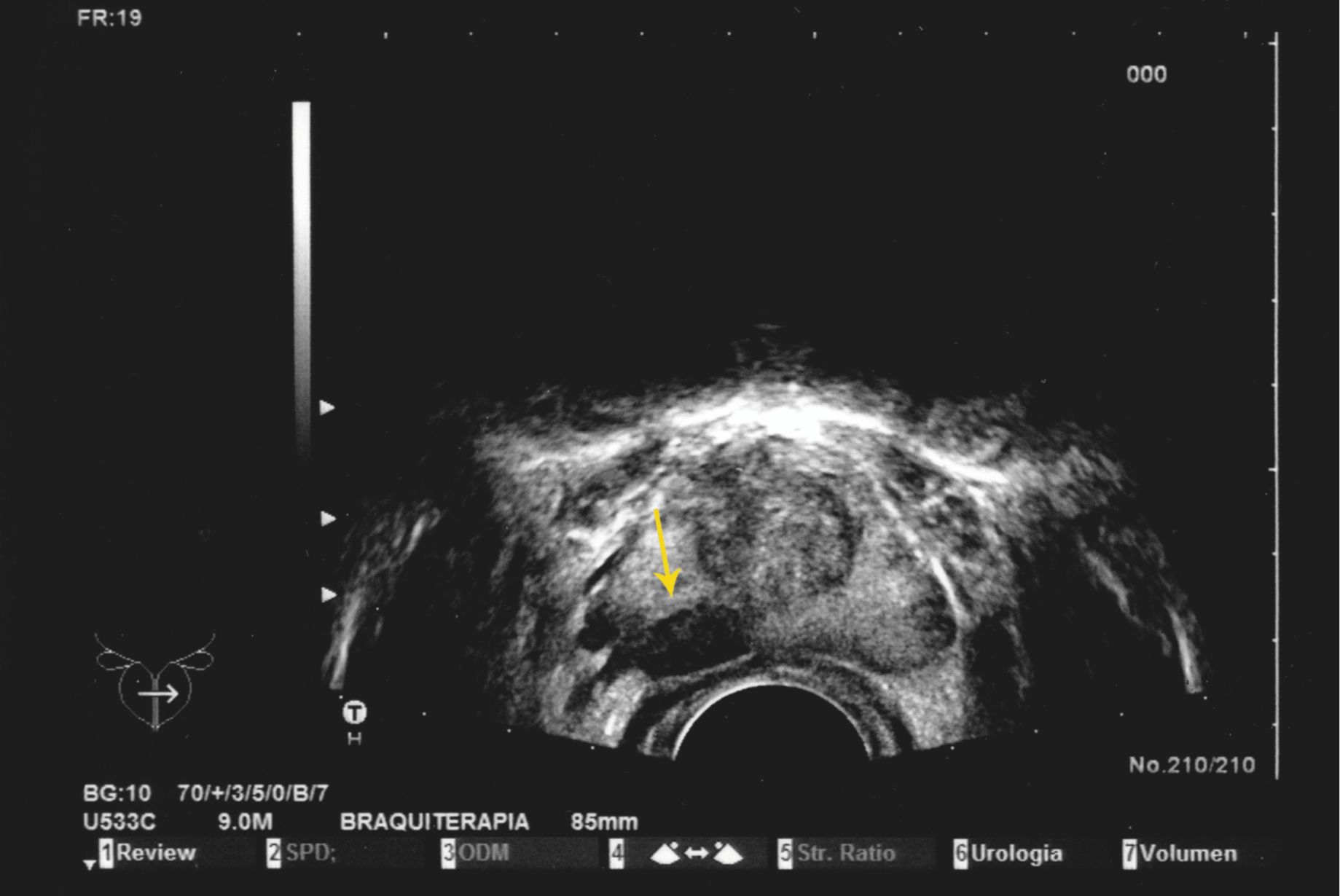 Próstata con tumor en glándula prostática